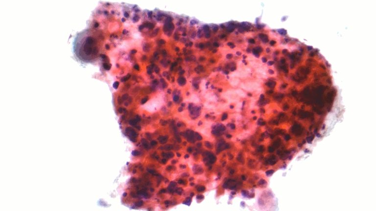 Non-Small Cell Lung Cancer (NSCLC)