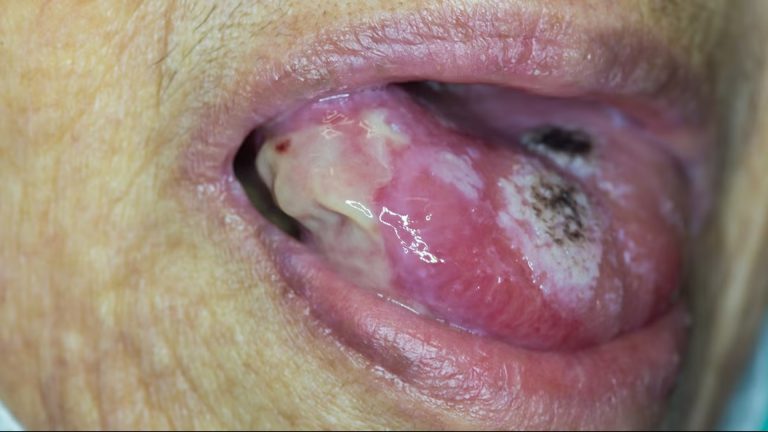Oral Cavity Cancer (Mouth Cancer)
