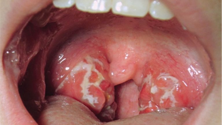 oropharyngeal-cancer-throat-cancer