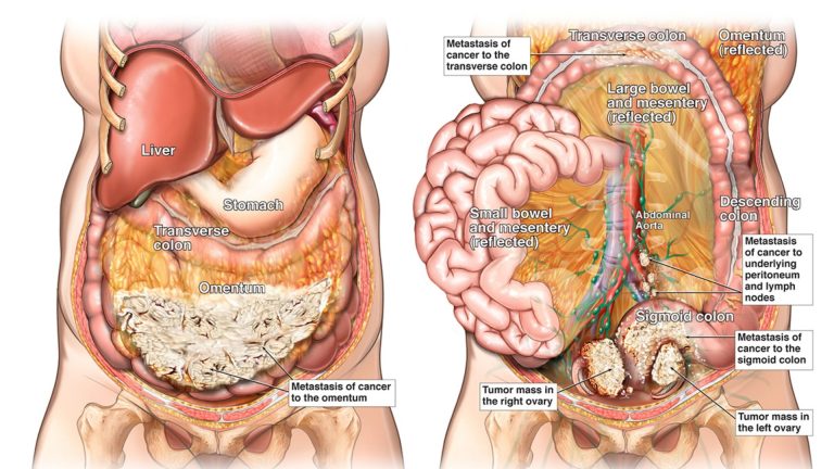 Ovarian Cancer (Ovarian Carcinoma)