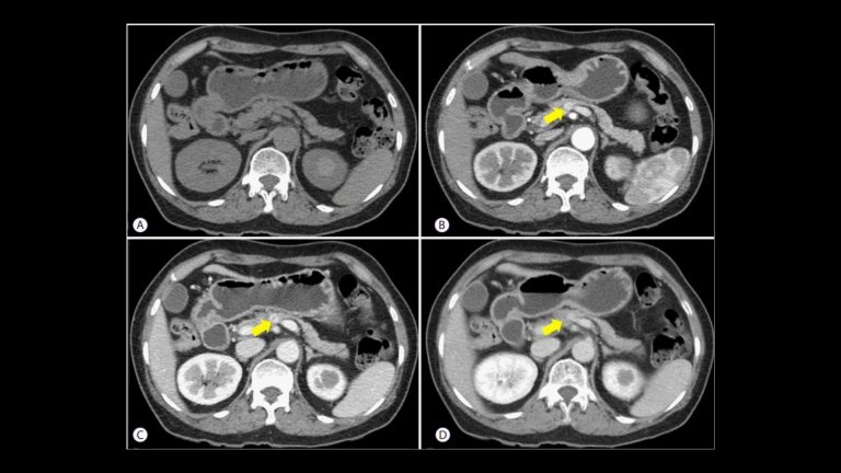 Pancreatic Neuroendocrine Tumor (Islet Cell Tumor)