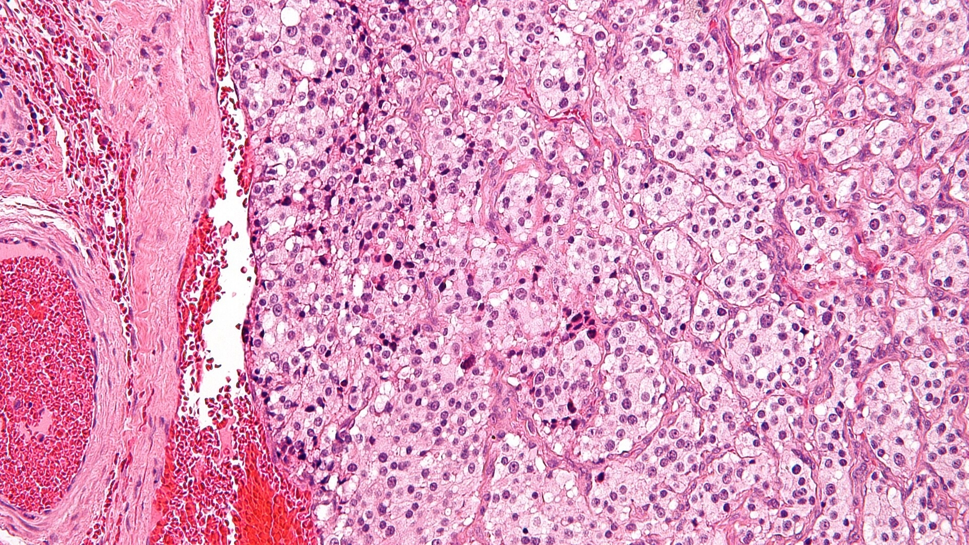 Paraganglioma