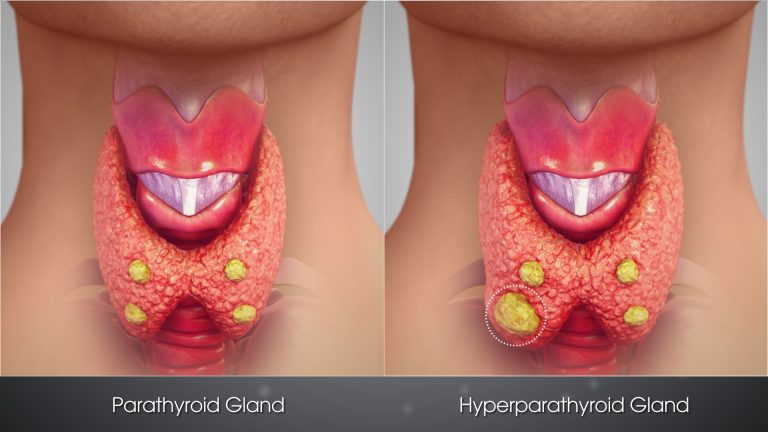 Parathyroid Cancer (Parathyroid Carcinoma)
