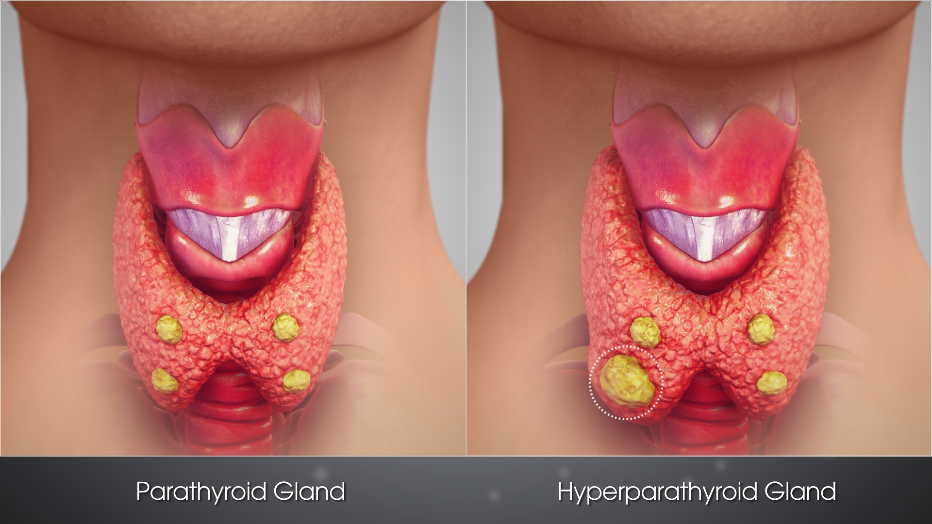 Parathyroid Cancer (Parathyroid Carcinoma)