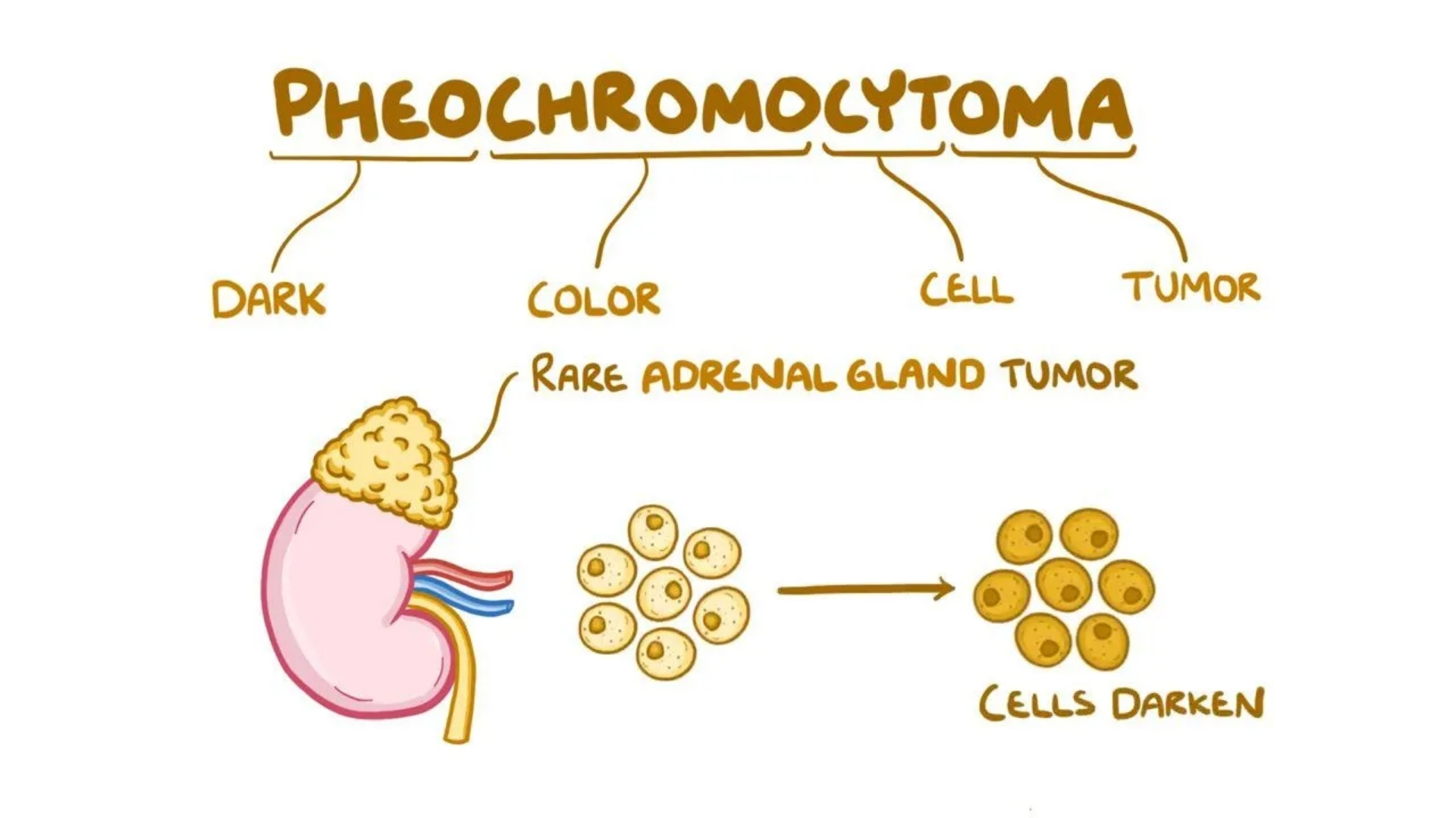 Pheochromocytoma