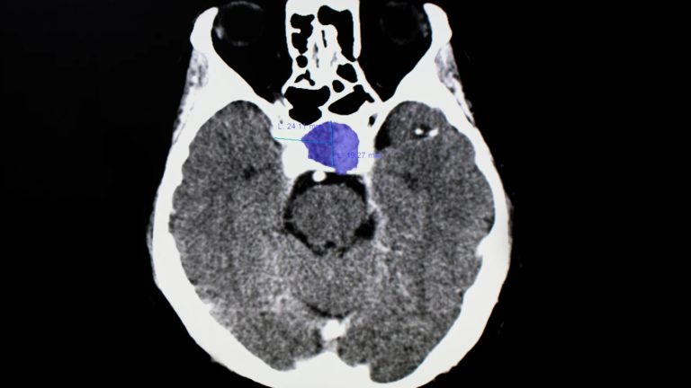 Pituitary Tumor (Pituitary Adenoma)