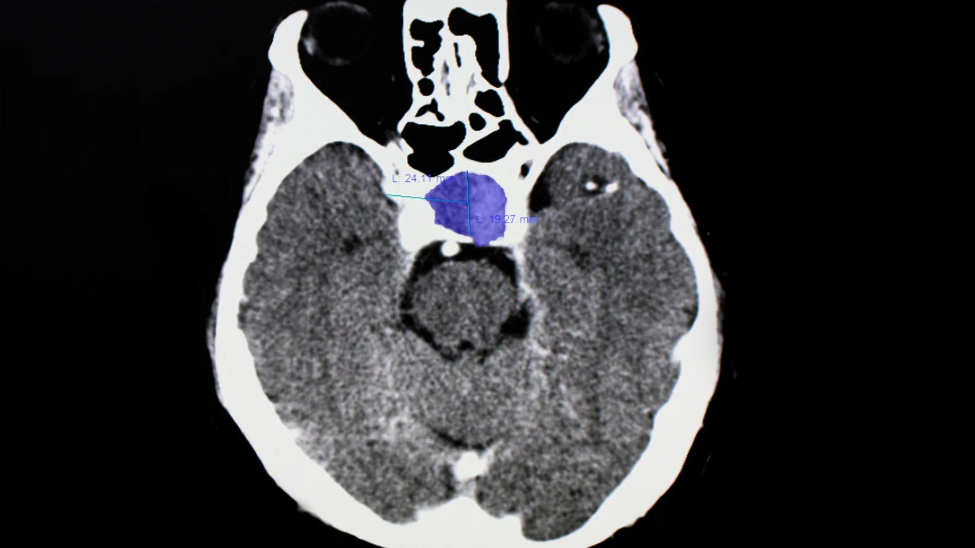 Pituitary Tumor (Pituitary Adenoma)