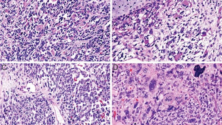 Pleuropulmonary Blastoma (PPB)