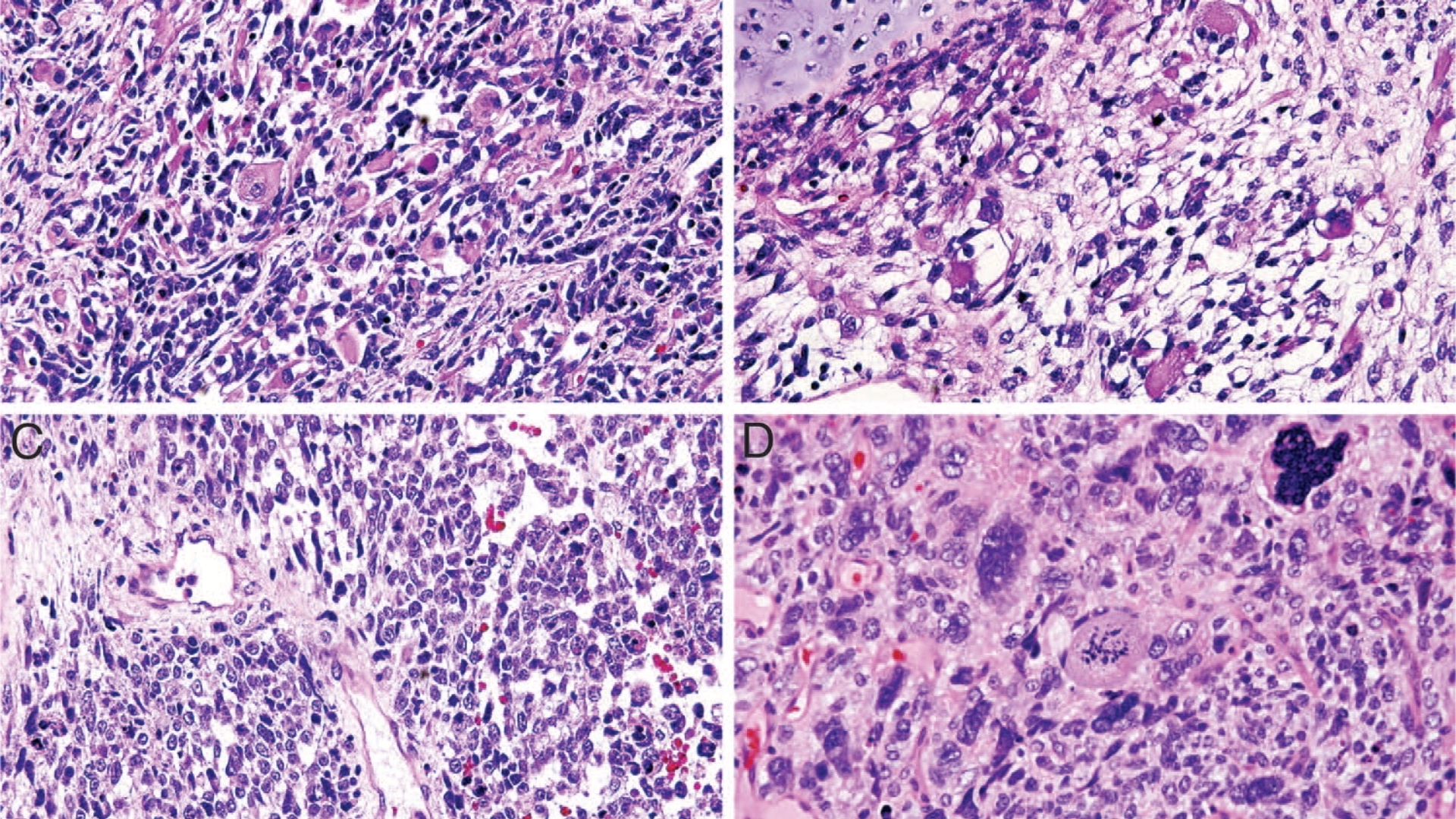 Pleuropulmonary Blastoma (PPB)