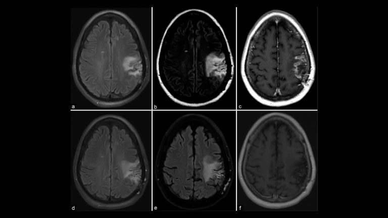 Primary CNS Lymphoma