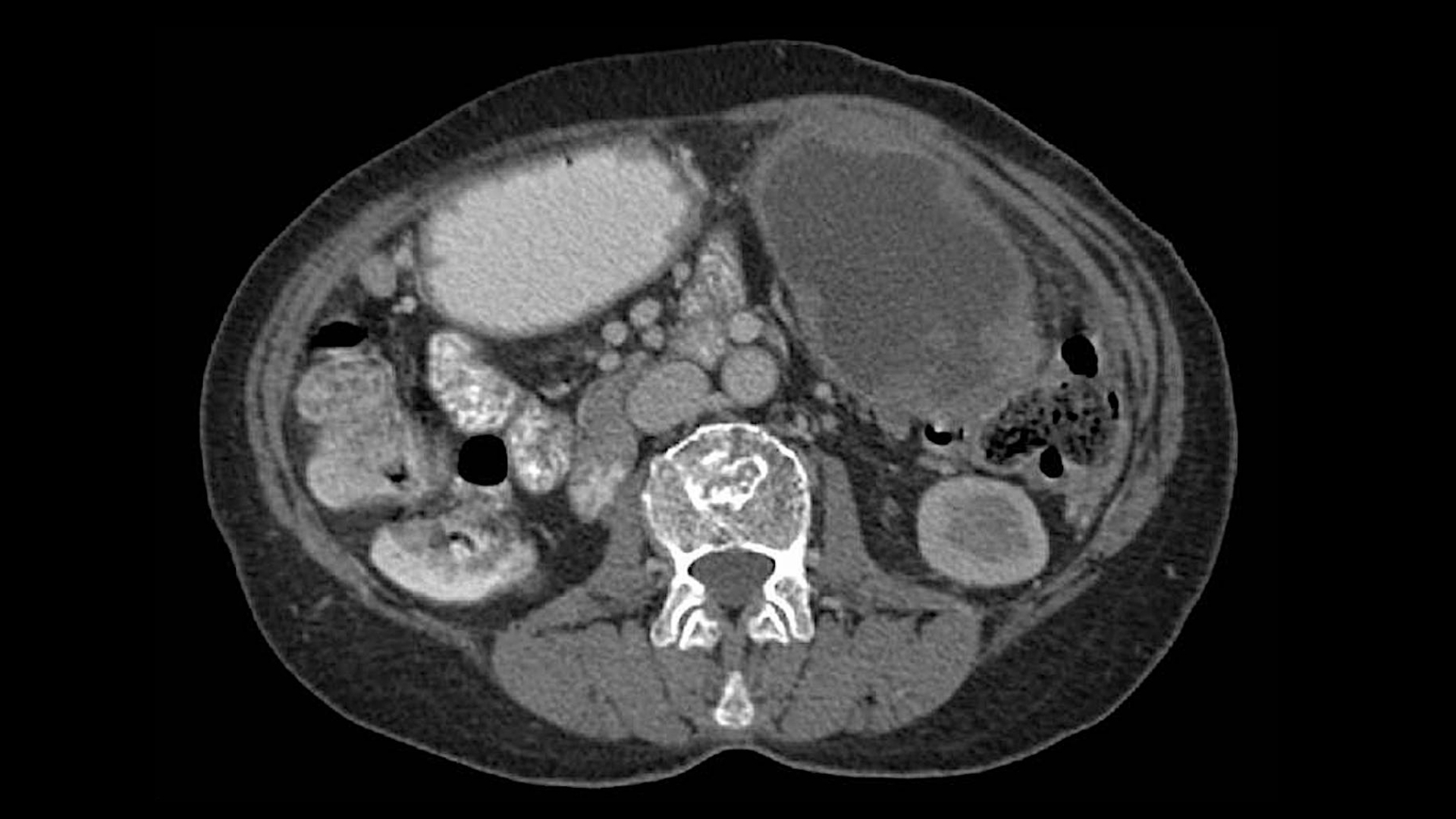Primary Peritoneal Cancer (Primary Peritoneal Carcinoma)