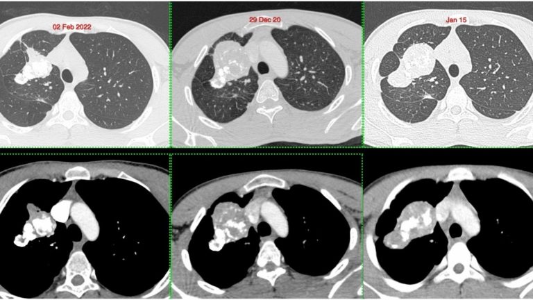 Pulmonary Inflammatory Myofibroblastic Tumor