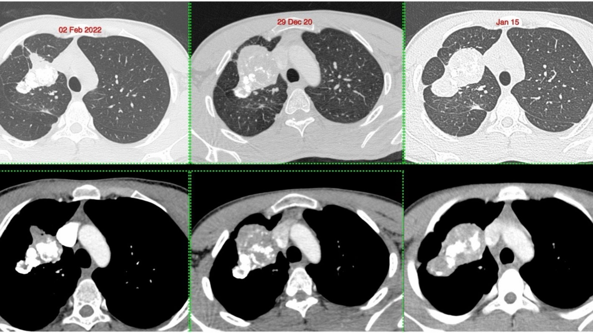 Pulmonary Inflammatory Myofibroblastic Tumor