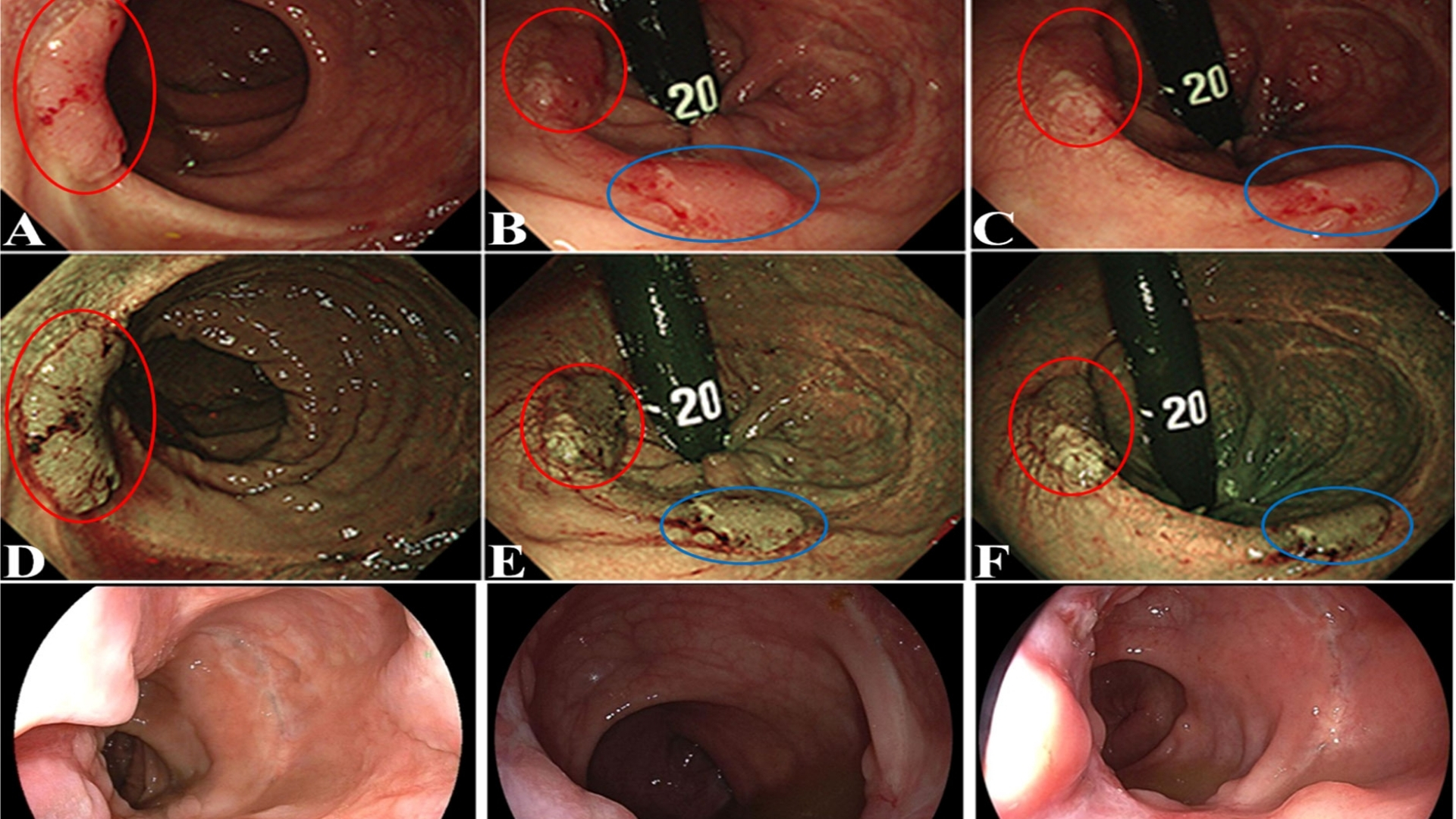 Rectal Cancer (Rectal Carcinoma)
