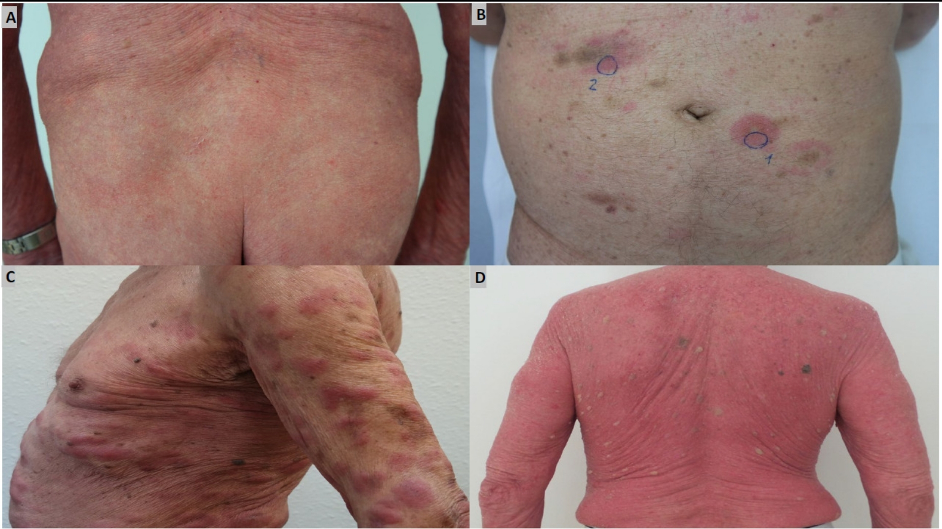 Sézary syndrome (Leukemic Cutaneous T-Cell Lymphoma)