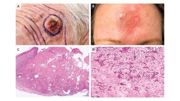 Skin Cancer (Cutaneous Carcinoma)