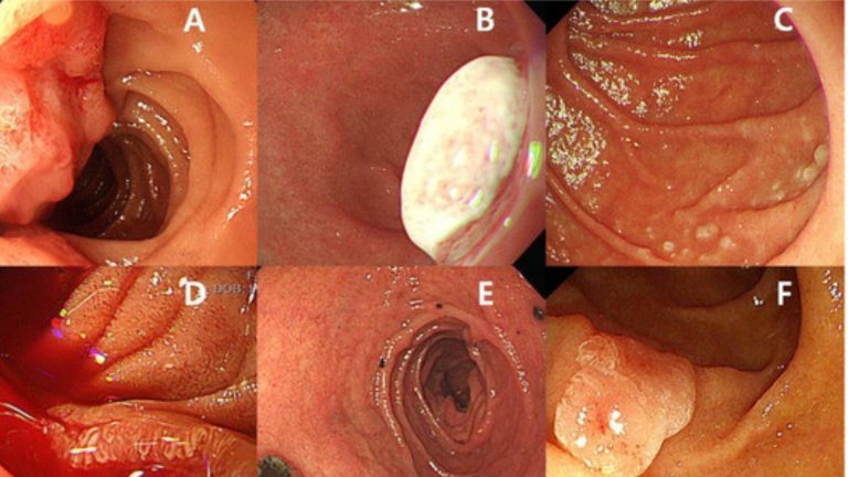 Small Intestine Cancer (Small Bowel Carcinoma)