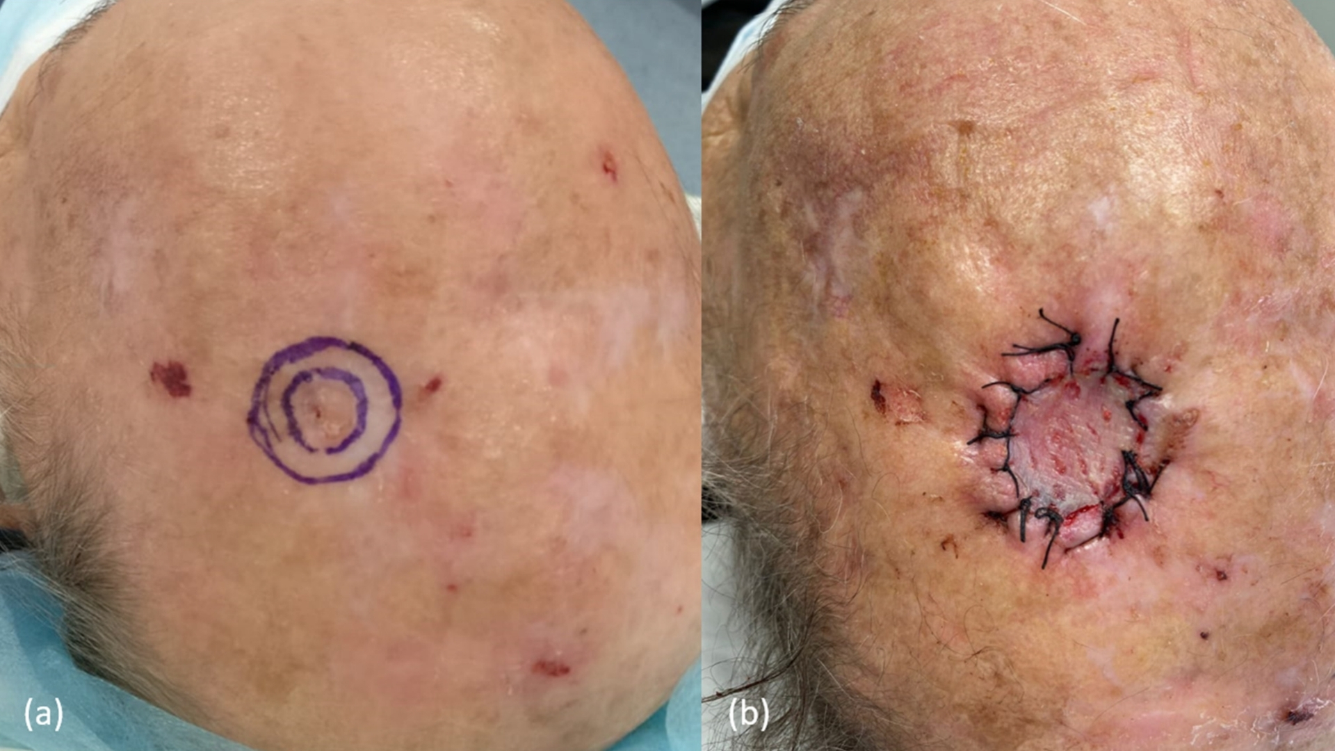 squamous-cell-skin-cancer-squamous-cell-carcinoma