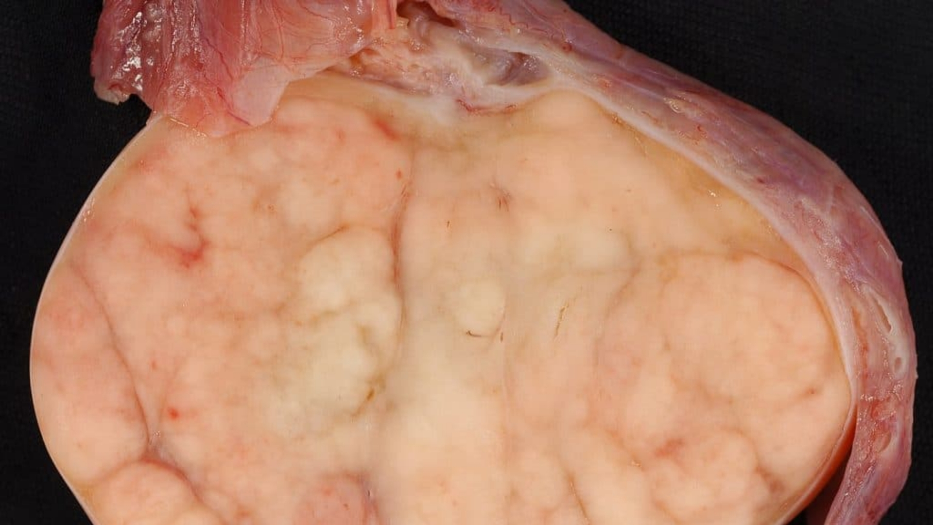 testicular-cancer-testicular-germ-cell-tumor