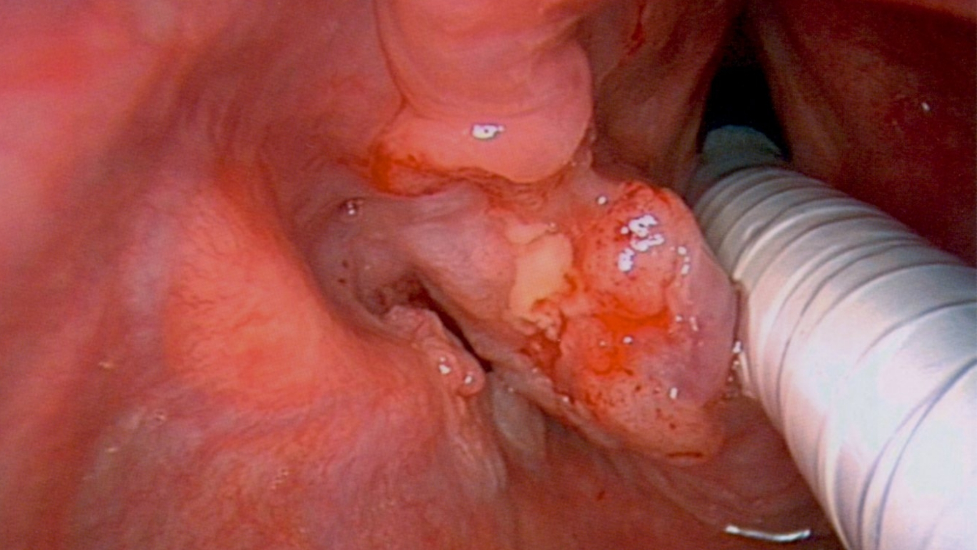 Throat Cancer (Pharyngeal Cancer)