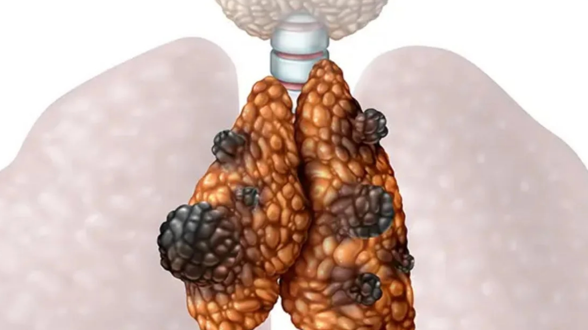 thymic-carcinoma-malignant-thymus-gland-tumor