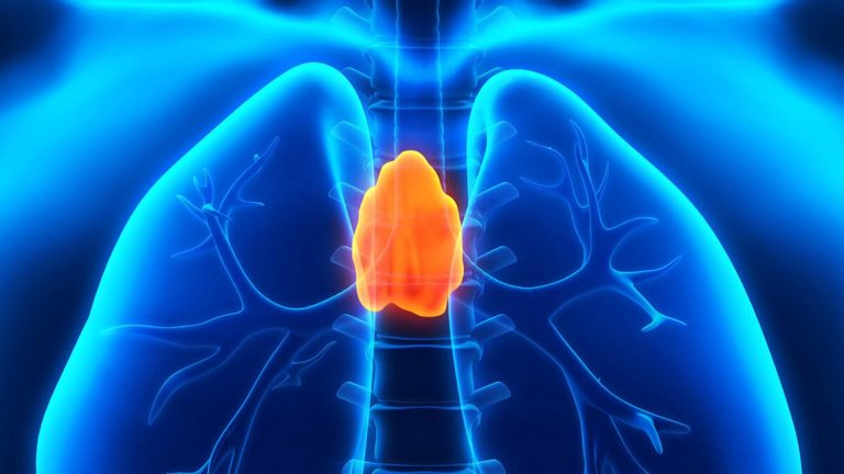 Thymoma (Thymus Gland Tumor)