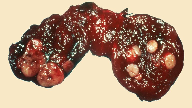 Thyroid Cancer (Thyroid Carcinoma)