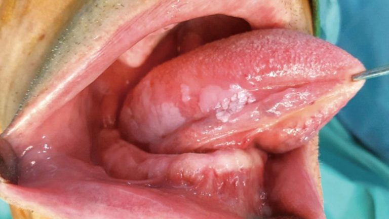 Tongue Cancer (Tongue Carcinoma)