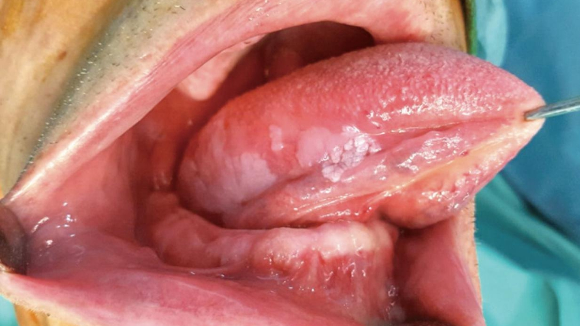 Tongue Cancer (Tongue Carcinoma)