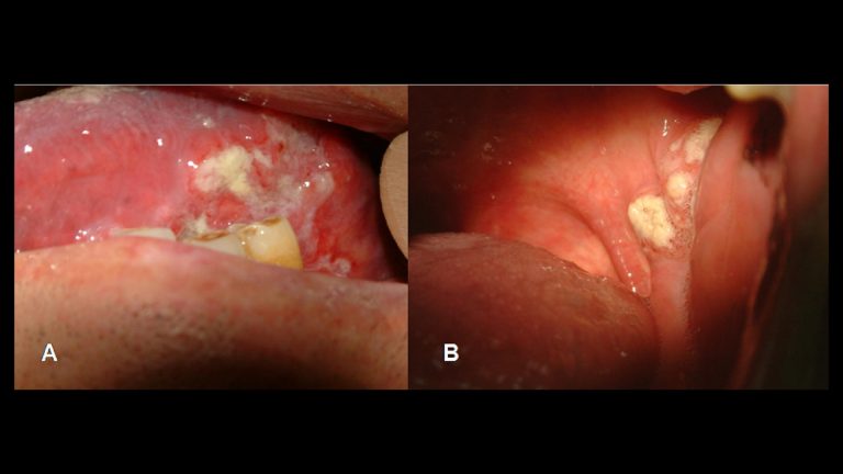 tonsil-cancer-tonsillar-carcinoma