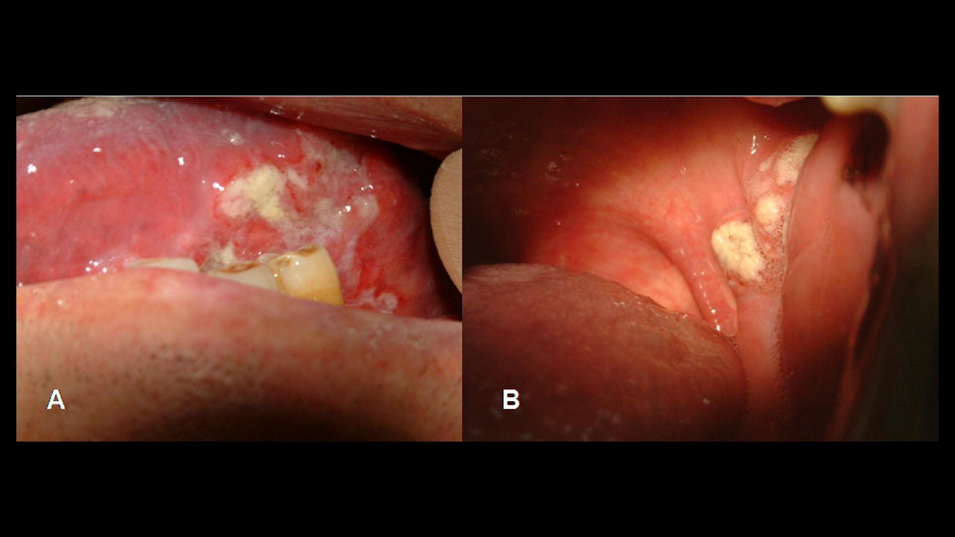 tonsil-cancer-tonsillar-carcinoma