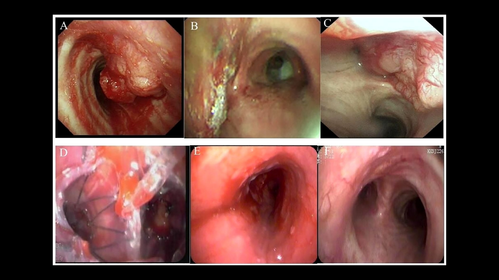 Tracheal Cancer (Tracheobronchial Tumor)