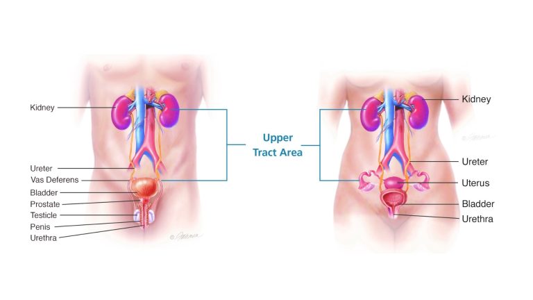 ureter-renal-pelvis-cancer-upper-urinary-tract-urothelial-carcinoma
