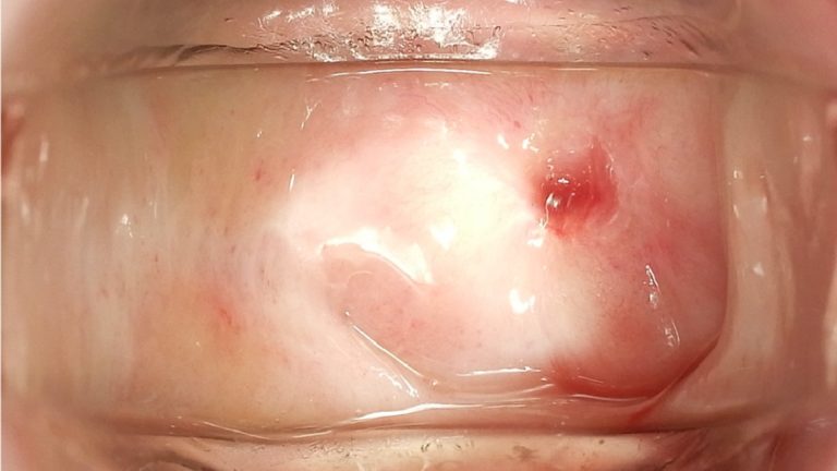 Urethral Cancer (Urethral Carcinoma)
