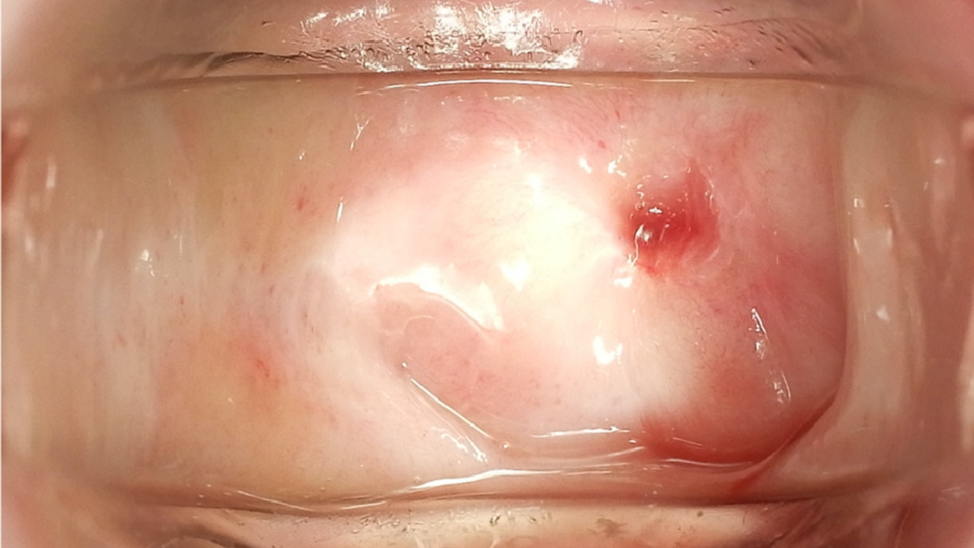 Urethral Cancer (Urethral Carcinoma)
