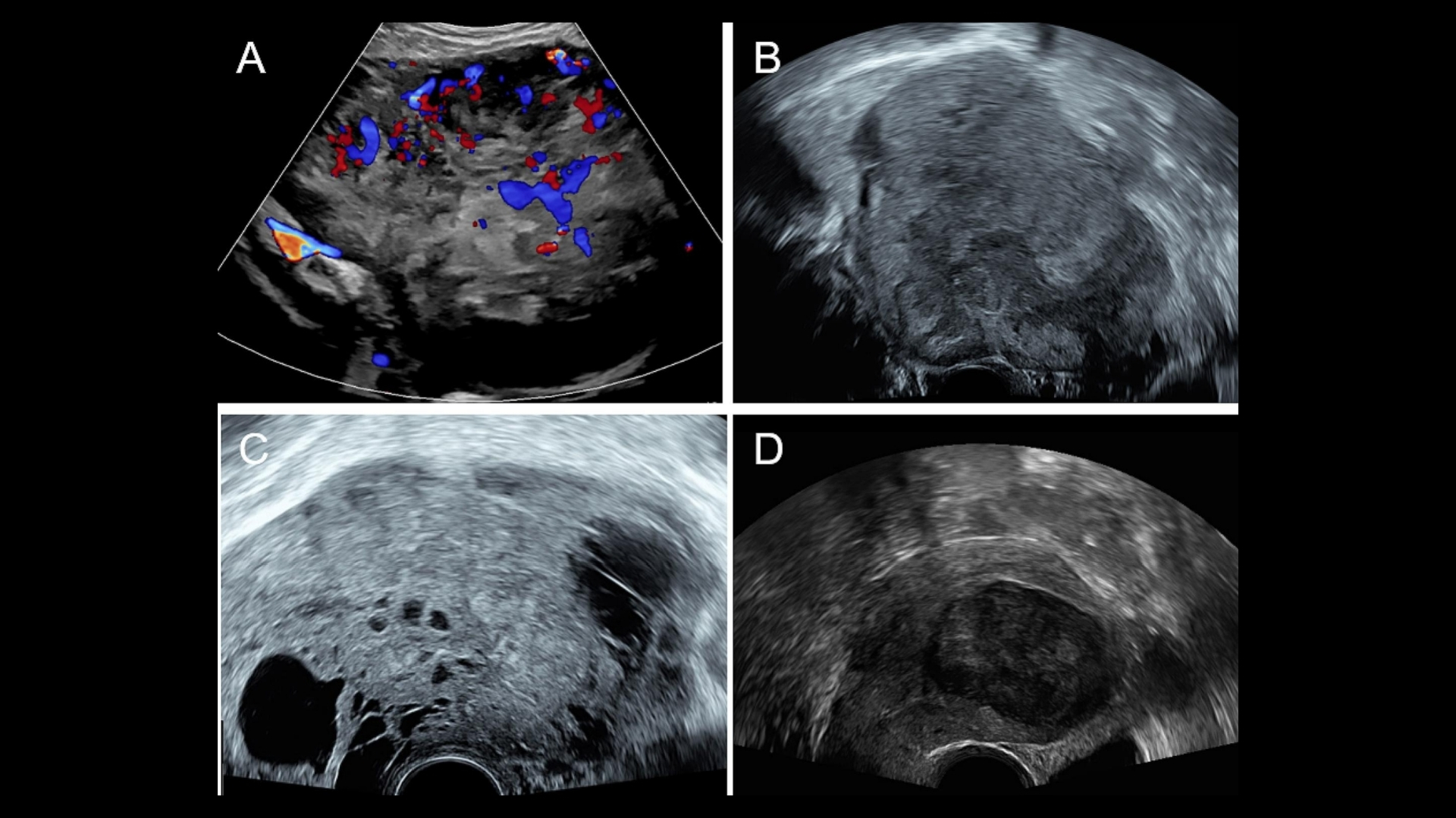 Uterine Sarcoma (Uterine Leiomyosarcoma)