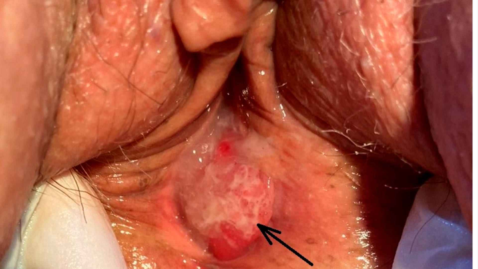 Vaginal Cancer (Vaginal Carcinoma)