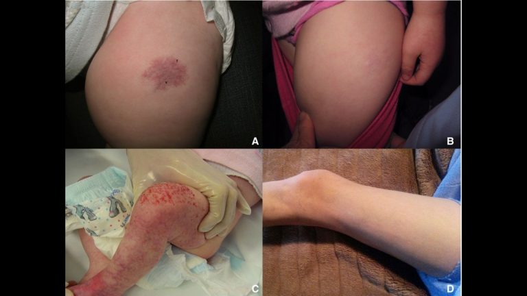 Vascular Tumor (Angiosarcoma)