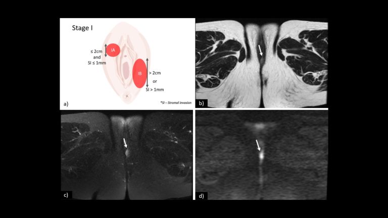 Vulvar Cancer