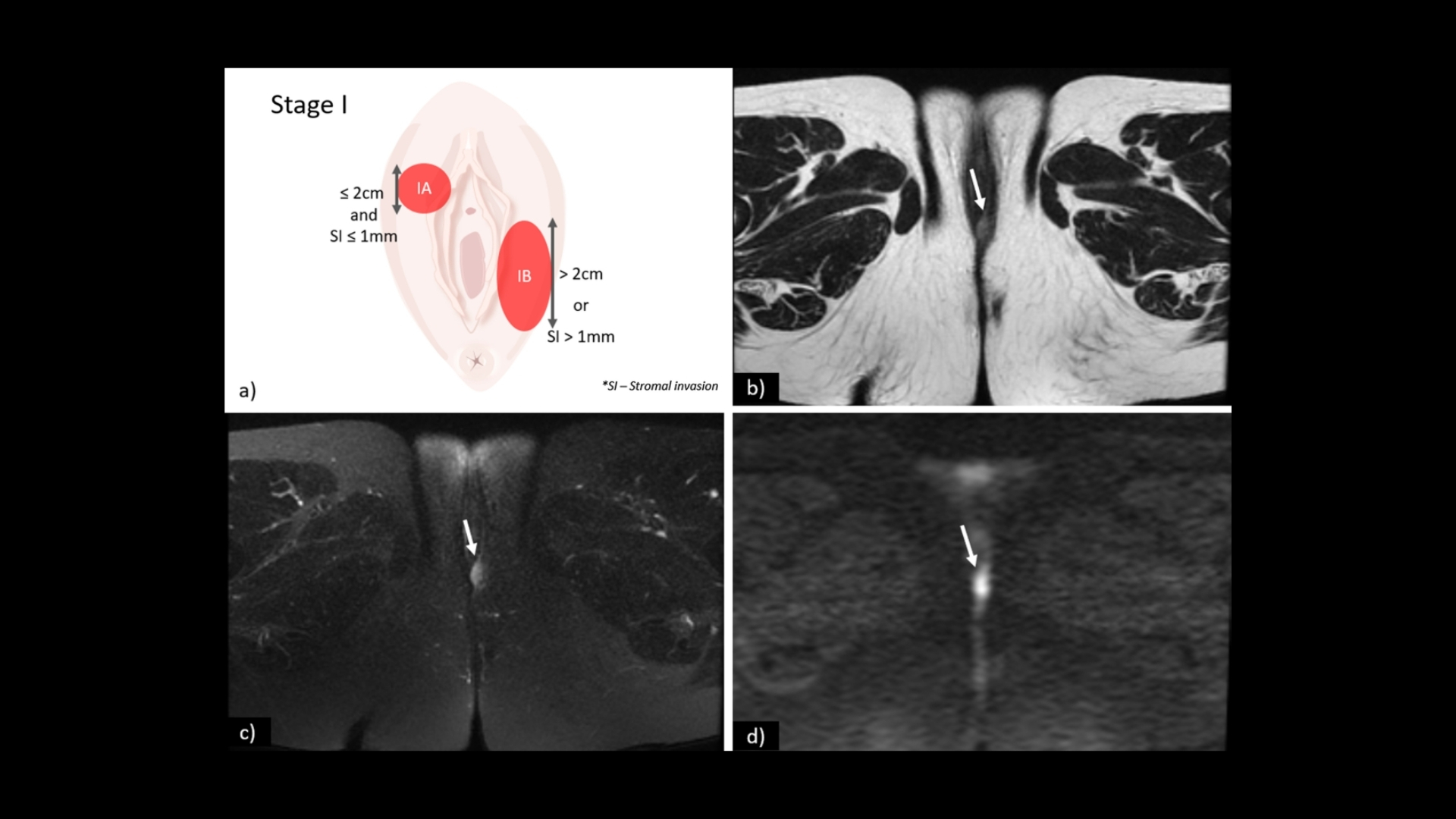 Vulvar Cancer