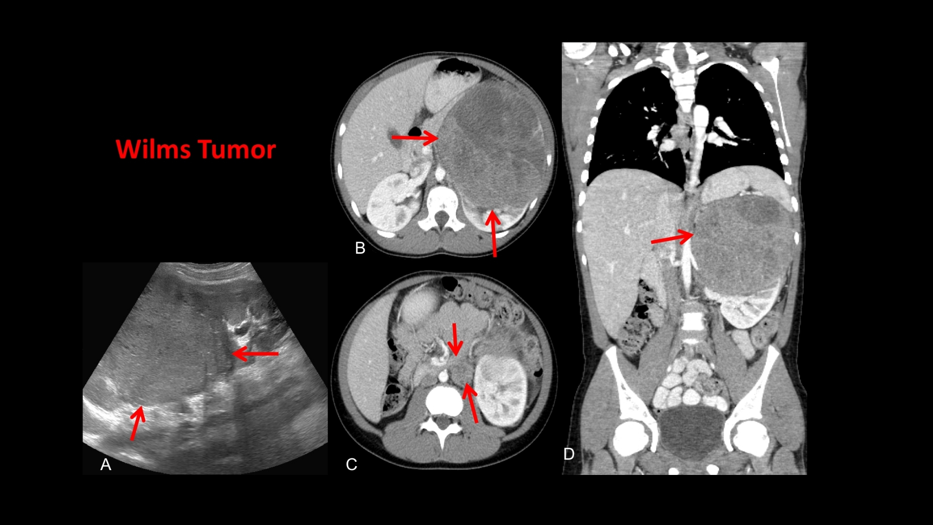 Wilms Tumor (Nephroblastoma)