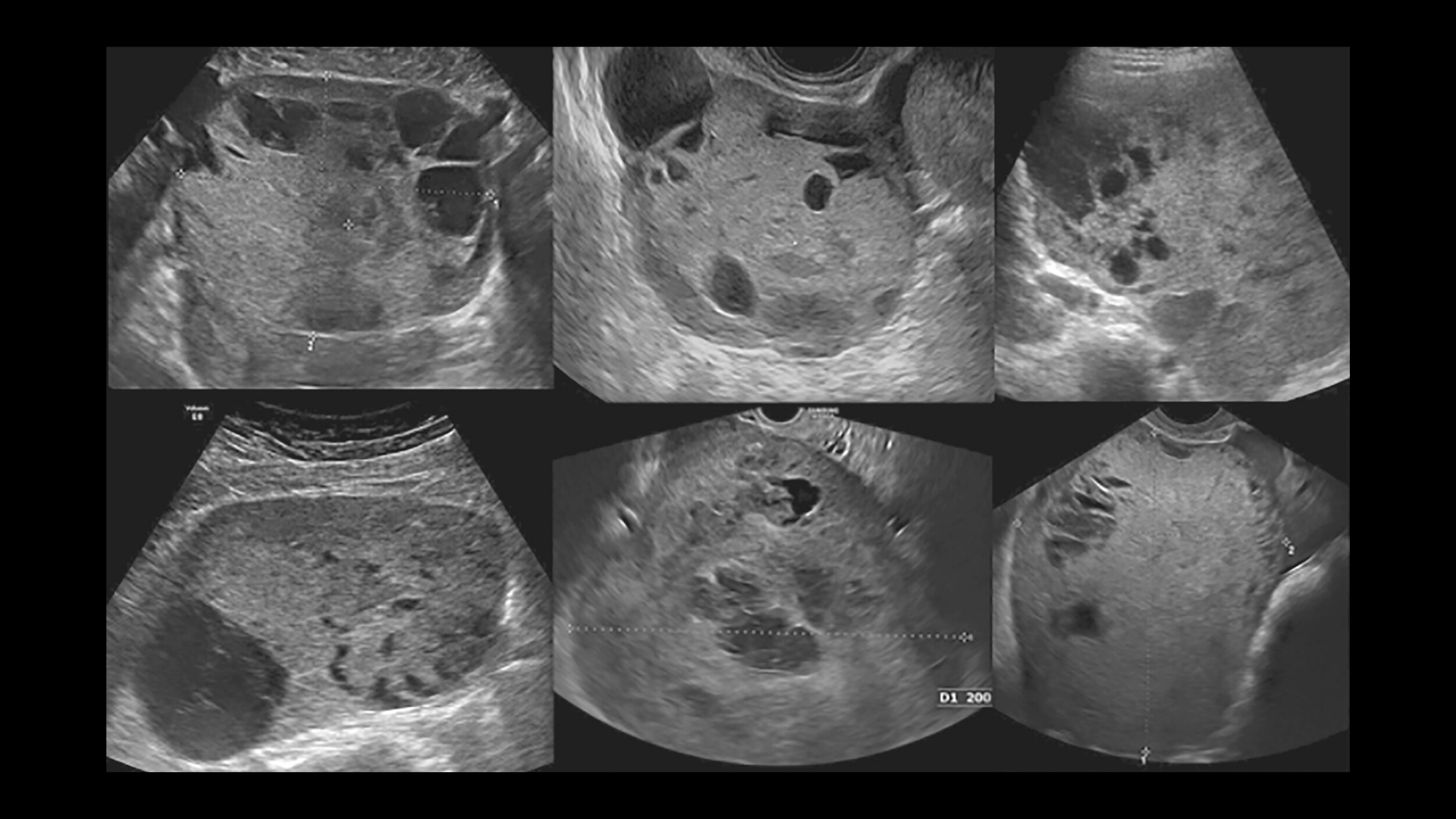 Yolk Sac Tumor