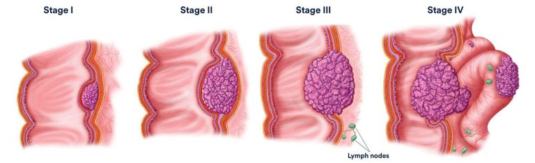 How I Knew I Had Colon Cancer: Real Stories, Symptoms, and Seeking Help